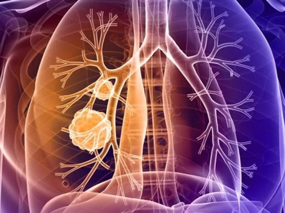 everything you need to know about lung cancer
